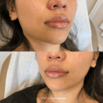 Before and after lower facial balancing
