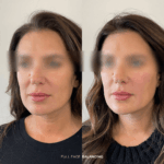 Before and after full facial balancing