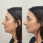Before and after lower facial balancing