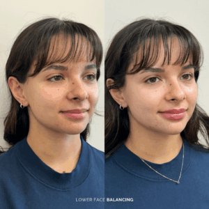 Before and after lower face balancing
