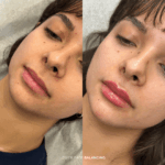 Before and after lower face balancing