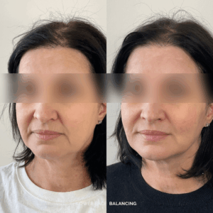 Before and after lower facial balancing treatment