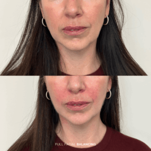 Before and after full facial balancing treatment