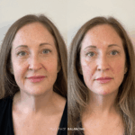 Before and after full facial balancing treatment
