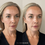 Before and after full facial balancing treatment