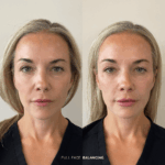 Before and after full facial balancing treatment