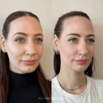 Before and after full facial balancing treatment