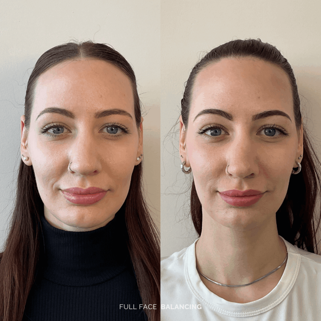 Before and after full facial balancing treatment