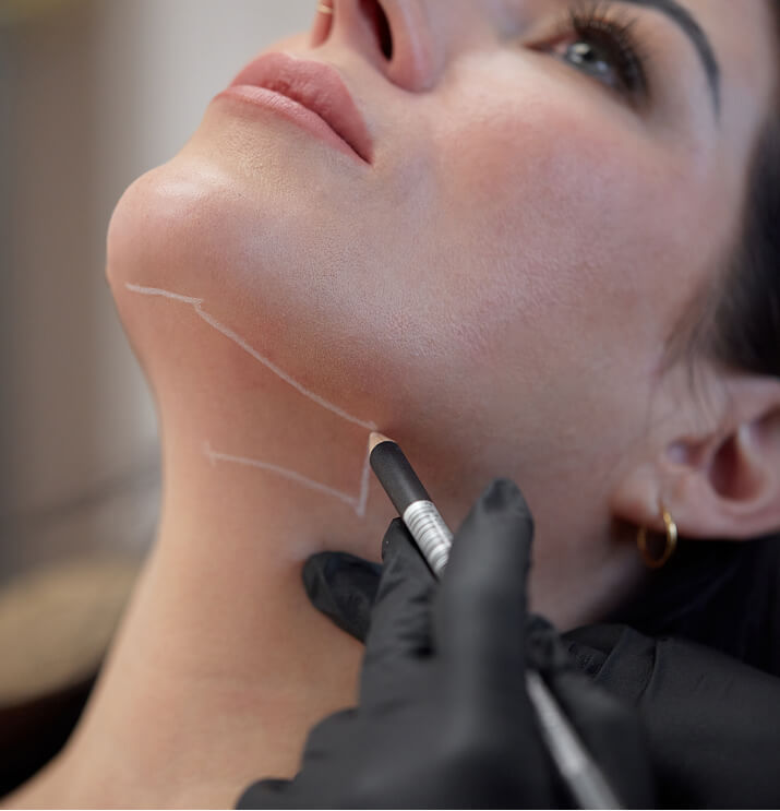 Jawline markings for belkyra fat dissolving treatment at the symm label in Calgary