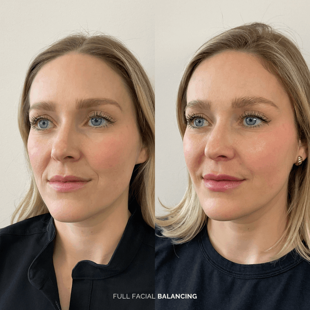 Before and after full facial balancing treatment