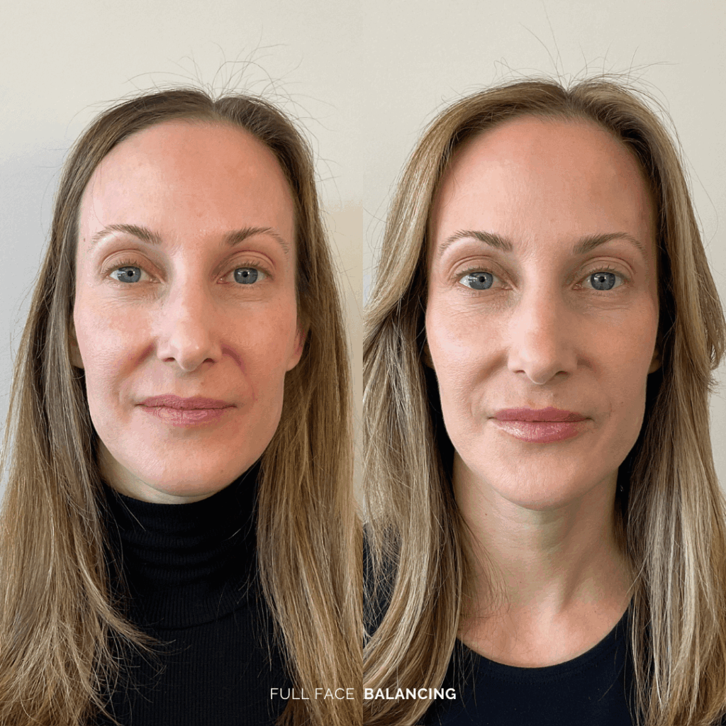 Before and after full facial balancing treatment
