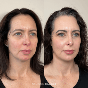 before and after full facial balancing treatment