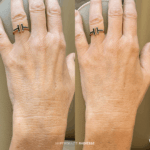 Before and after hyperdilute radiesse hands treatment