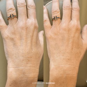 Before and after hyperdilute radiesse hands treatment
