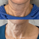 Before and after hyperdilute radiesse neck treatment