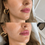 Before and after lip augmentation treatment