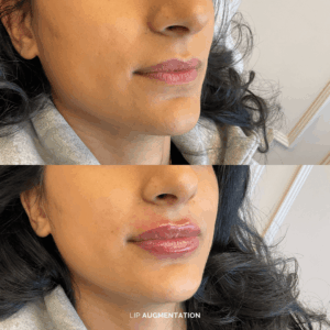 Before and after lip augmentation treatment