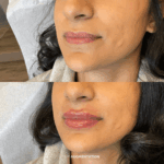 Before and after lip augmentation treatment