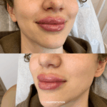 Before and after lip augmentation treatment