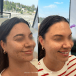 Before and after crow’s feet treatment with neuromodulators