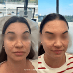 Before and after forehead treatment with neuromodulators
