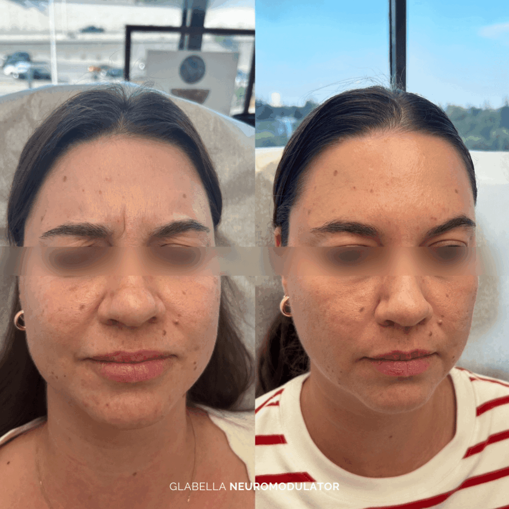 Before and after glabella treatment