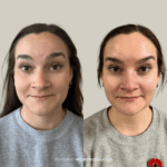 Before and after forehead treatment with neuromodulator