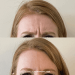 Before and after glabella treatment with neuromodulators