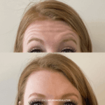 Before and after glabella treatment with neuromodulators