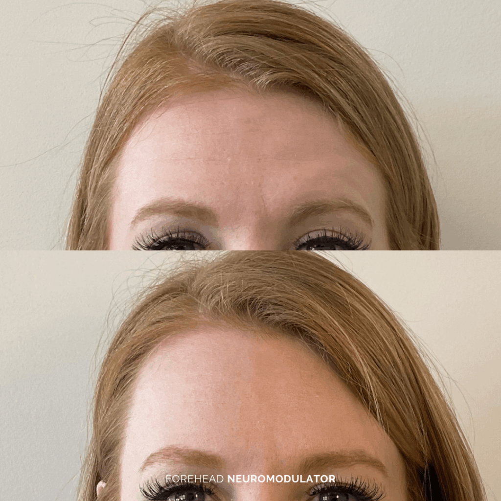 Before and after forehead treatment with neuromodulator