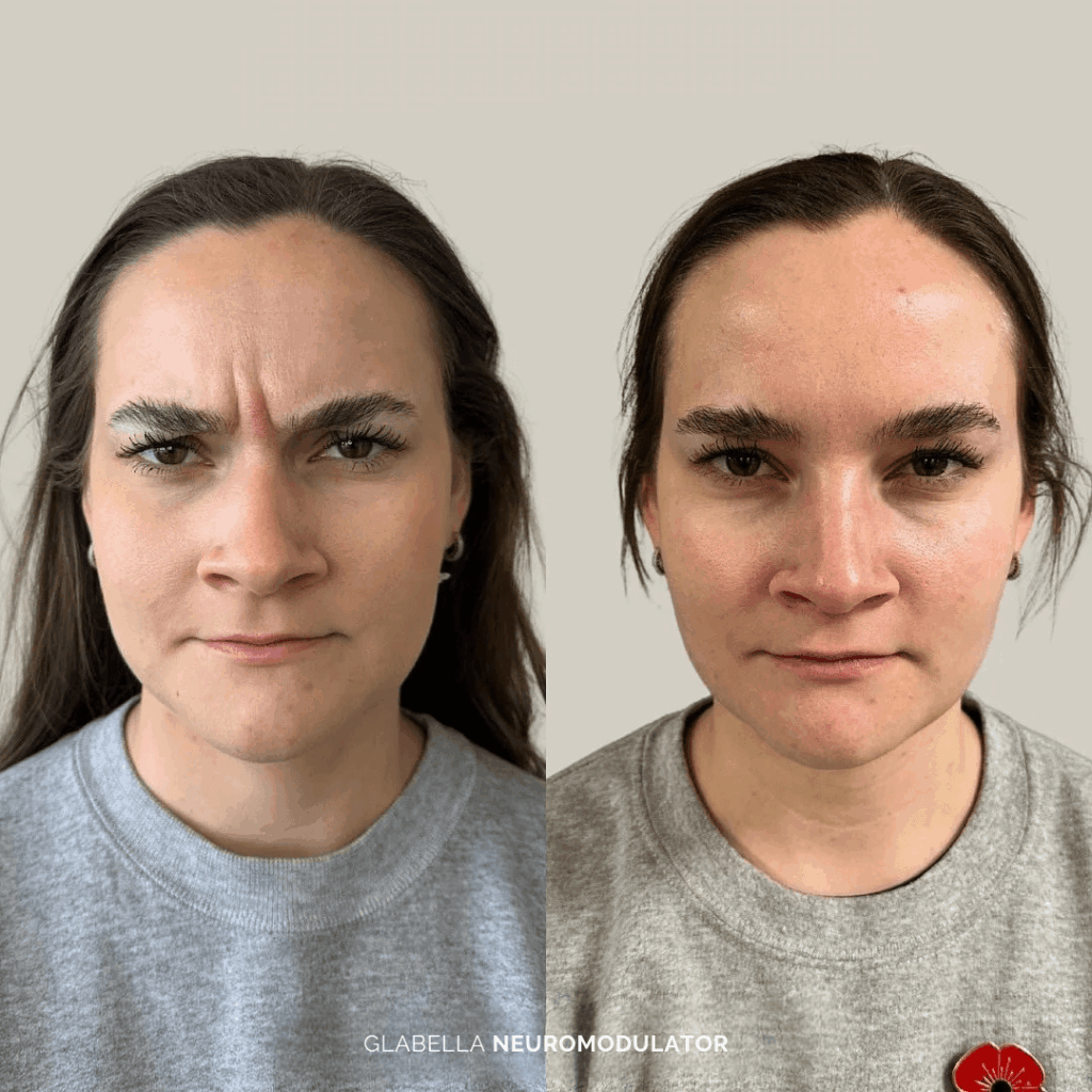 Before and after glabella treatment with neuromodulator