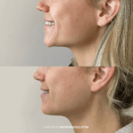 Before and after mentalis treatment with neuromodulator