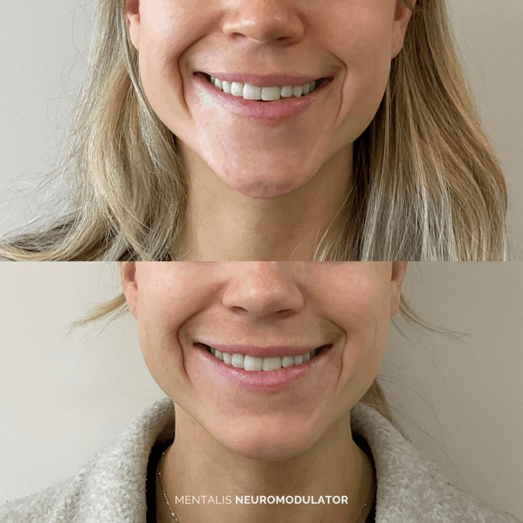 Before and after mentalis treatment with neuromodulator