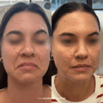 Before and after DAO treatment with neuromodulators