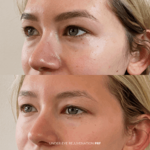 Before and after under-eye rejuvenation with PRF