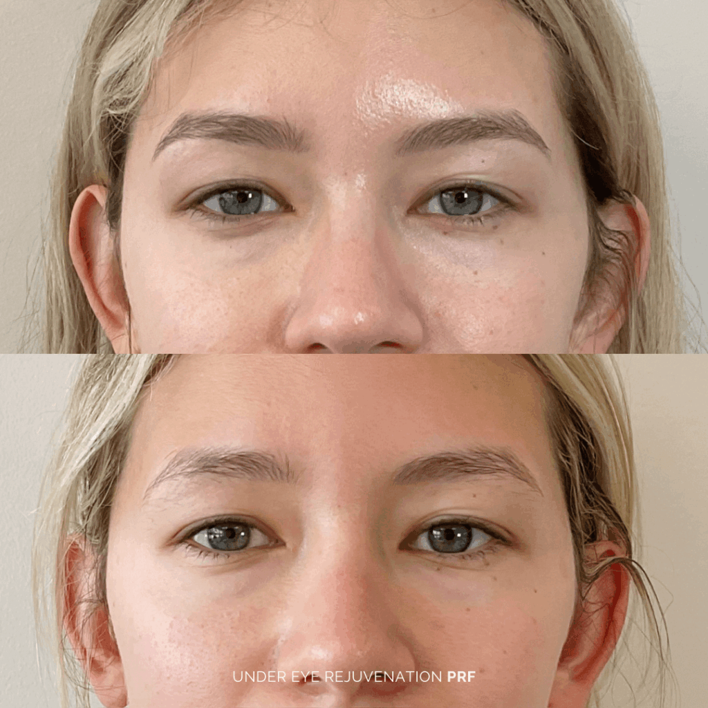 Before and after under-eye rejuvenation with PRF