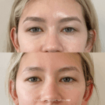 Before and after under-eye rejuvenation with PRF