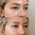 Before and after under-eye rejuvenation with PRF