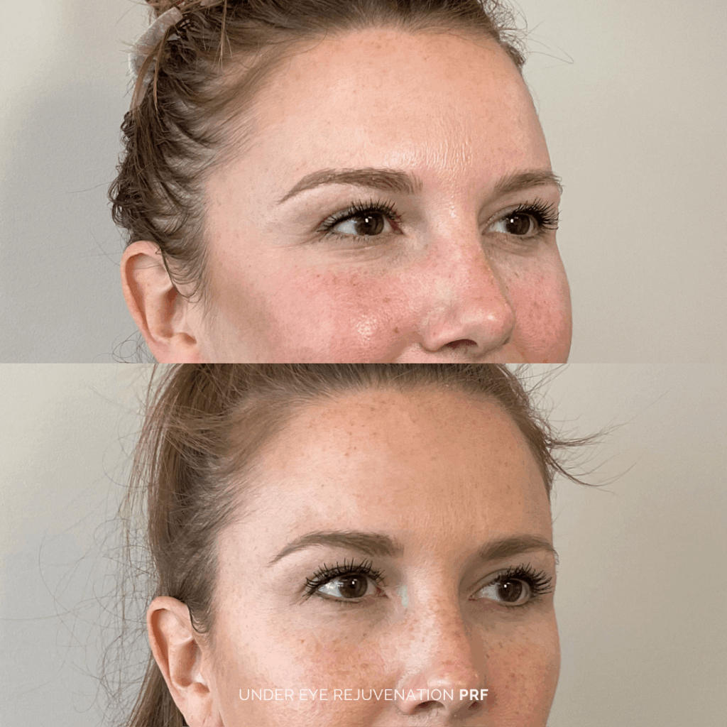 Before and after under-eye rejuvenation with PRF