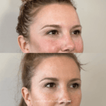 Before and after under-eye rejuvenation with PRF