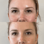 Before and after under-eye rejuvenation with PRF