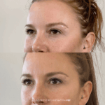 Before and after under-eye rejuvenation with PRF