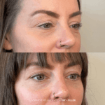 before and after under eye rejuvenation PRF + filler