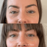before and after under eye rejuvenation PRF + filler