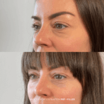before and after under eye rejuvenation PRF + filler