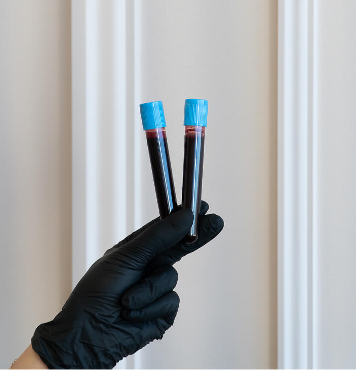 Blood sample tubes prepared for PRF treatment at the symm label in Calgary