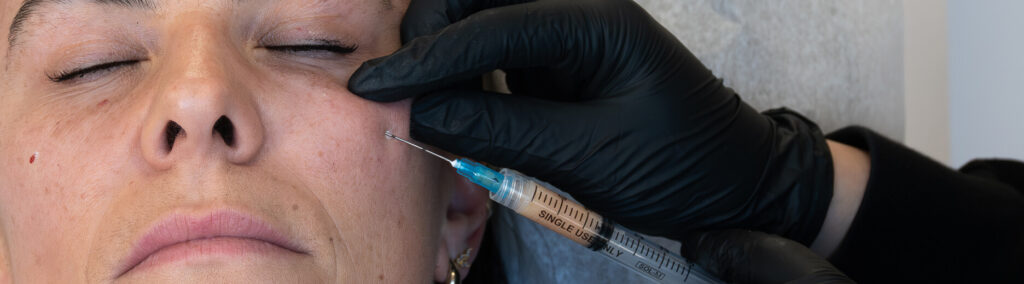 Close-up of woman receiving PRF injection under eyes at the symm label in Calgary
