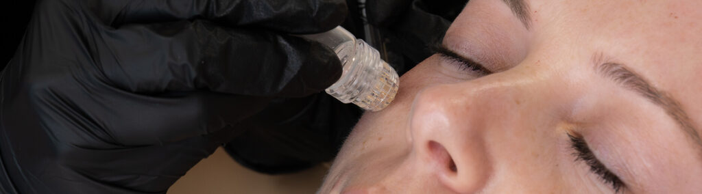 Close-up of client receiving VAMP PDRN treatment on cheek at the symm label in Calgary