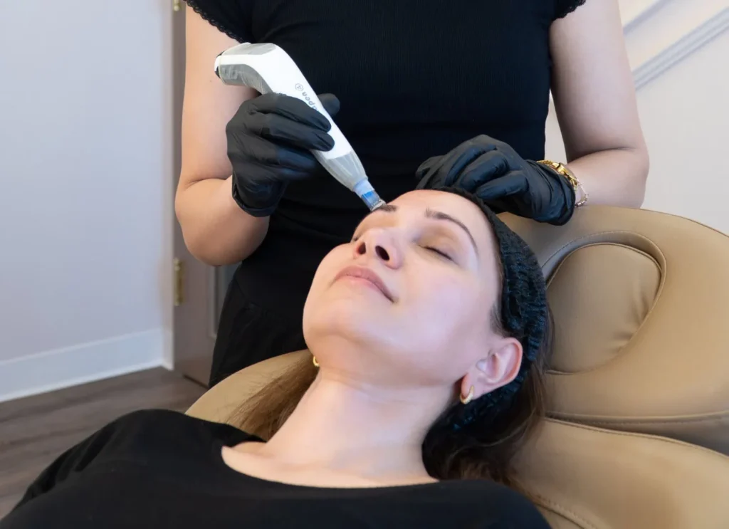 woman receiving microneedling against acne scars