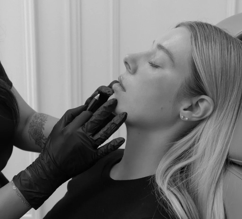 Close-up of patient receiving lip fillers in Calgary